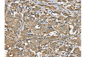 The image on the left is immunohistochemistry of paraffin-embedded Human breast cancer tissue using ABIN7192325(SERPINA11 Antibody) at dilution 1/35, on the right is treated with synthetic peptide. (SERPINA11 anticorps)