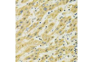 Immunohistochemistry of paraffin-embedded human liver cancer using HSPA9 antibody.