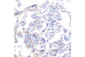 Immunohistochemistry of paraffin-embedded human lung cancer using SSTR5 Rabbit mAb (ABIN7270495) at dilution of 1:100 (40x lens).