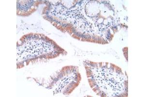 IHC-P analysis of Human Stomach Cancer Tissue, with DAB staining. (GLTP anticorps  (AA 2-209))