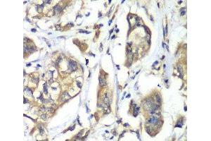 Immunohistochemistry of paraffin-embedded Human liver cancer using NFS1 Polyclonal Antibody at dilution of 1:100 (40x lens).