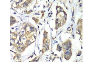 Immunohistochemistry of paraffin-embedded Human liver cancer using NFS1 Polyclonal Antibody at dilution of 1:100 (40x lens). (NFS1 anticorps)