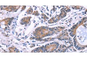 Immunohistochemistry of paraffin-embedded Human colon cancer using SYT4 Polyclonal Antibody at dilution of 1:60 (SYT4 anticorps)