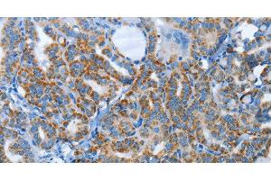 Immunohistochemistry of paraffin-embedded Human thyroid cancer tissue using AGL Polyclonal Antibody at dilution 1:30