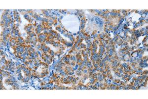 Immunohistochemistry of paraffin-embedded Human thyroid cancer tissue using AGL Polyclonal Antibody at dilution 1:30 (AGL anticorps)