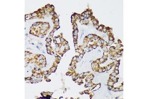Immunohistochemistry of paraffin-embedded Human thyroid cancer using Septin 8 Rabbit pAb (ABIN7265350) at dilution of 1:100 (40x lens). (Septin 8 anticorps  (AA 348-427))