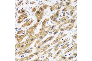 Immunohistochemistry of paraffin-embedded human liver cancer using HAPLN1 antibody. (HAPLN1 anticorps)
