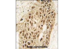 Formalin-fixed and paraffin-embedded human lung carcinoma tissue reacted with Dnmt3a antibody (N-term R46) , which was peroxidase-conjugated to the secondary antibody, followed by DAB staining. (DNMT3A anticorps  (N-Term))