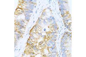 Immunohistochemistry of paraffin-embedded human colon carcinoma using BMP2 antibody at dilution of 1:100 (40x lens). (BMP2 anticorps)