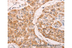 Immunohistochemistry of Human lung cancer using GNA11 Polyclonal Antibody at dilution of 1:40