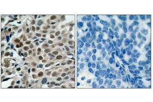 Immunohistochemical analysis of paraffin-embedded human breast carcinoma tissue using FKHRL1 (phospho-Ser253) antibody. (FOXO3 anticorps  (pSer253))