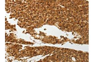 The image on the left is immunohistochemistry of paraffin-embedded Human liver cancer tissue using ABIN7192598(SOCS7 Antibody) at dilution 1/30, on the right is treated with synthetic peptide. (SOCS7 anticorps)