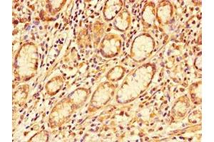 Immunohistochemistry of paraffin-embedded human gastric cancer using ABIN7163856 at dilution of 1:100 (GALNT11 anticorps  (AA 420-606))