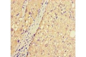 Immunohistochemistry of paraffin-embedded human liver cancer using ABIN7144175 at dilution of 1:100 (ASB1 anticorps  (AA 1-300))