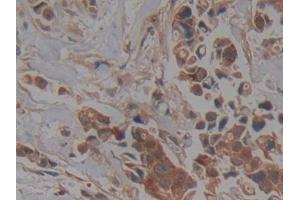 Detection of PKCi in Human Breast cancer Tissue using Polyclonal Antibody to Protein Kinase C Iota (PKCi) (PKC iota anticorps  (AA 375-596))