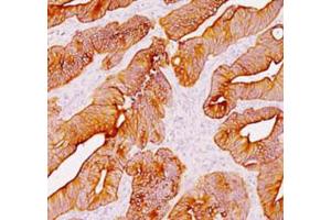 Immunohistochemical staining (Formalin-fixed paraffin-embedded sections) analysis of human colon with Pan Cytokeratin monoclonal antibody, clone AE1 + AE3  at 1:200 using peroxidase-conjugate and DAB chromogen. (Keratin 77 anticorps)