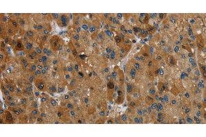 Immunohistochemistry of paraffin-embedded Human liver cancer tissue using HSD17B14 Polyclonal Antibody at dilution 1:40 (HSD17B14 anticorps)