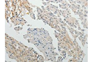 The image on the left is immunohistochemistry of paraffin-embedded Human cervical cancer tissue using ABIN7131158(SPATA17 Antibody) at dilution 1/15, on the right is treated with fusion protein. (SPATA17 anticorps)