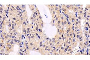 Detection of ERK2 in Human Thyroid cancer Tissue using Monoclonal Antibody to Extracellular Signal Regulated Kinase 2 (ERK2)