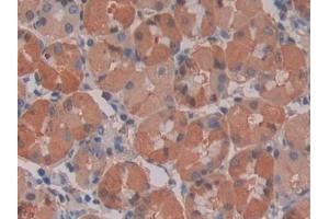 Detection of IL28A in Human Stomach cancer Tissue using Monoclonal Antibody to Interleukin 28A (IL28A)