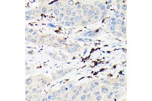 Immunohistochemistry of paraffin-embedded human esophageal cancer using CORO1A Rabbit pAb (ABIN6133495, ABIN6138903, ABIN6138904 and ABIN6224969) at dilution of 1:100 (40x lens).