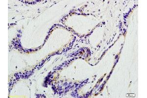 Formalin-fixed and paraffin embedded human colon carcinoma labeled with Anti-beta Defensin 1 Polyclonal Antibody, Unconjugated  at 1:200 followed by conjugation to the secondary antibody and DAB staining.