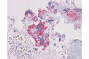 Anti-PTHR / PTHR1 antibody IHC of human Bone, Giant Cell Tumor. (PTH1R anticorps  (N-Term))