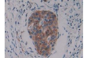 Detection of PKIb in Human Pancreatic cancer Tissue using Polyclonal Antibody to Protein Kinase Inhibitor Beta (PKIb)