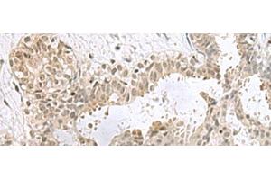 Immunohistochemistry of paraffin-embedded Human breast cancer tissue using PCBD1 Polyclonal Antibody at dilution of 1:60(x200) (PCBD1 anticorps)