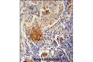 TYROBP Antibody immunohistochemistry analysis in formalin fixed and paraffin embedded human lung carcinoma followed by peroxidase conjugation of the secondary antibody and DAB staining. (TYROBP anticorps  (C-Term))