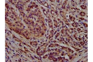 IHC image of ABIN7164816 diluted at 1:300 and staining in paraffin-embedded human pancreatic cancer performed on a Leica BondTM system. (PCCB anticorps  (AA 200-314))