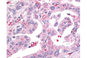 Anti-USP4 / UNP antibody IHC of human Pancreas, Carcinoma. (USP4 anticorps  (Internal Region))