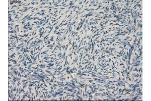 Immunohistochemical staining of paraffin-embedded Adenocarcinoma of colon tissue using anti-LTA4H mouse monoclonal antibody. (LTA4H anticorps)