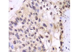 Immunohistochemistry of paraffin-embedded Human lung cancer using PSMA6 Polyclonal Antibody at dilution of 1:100 (40x lens). (PSMA6 anticorps)