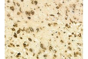 ABIN6265489 and ABIN6277939 at 1/100 staining human melanoma by IHC-P.