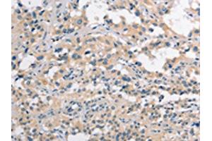 The image on the left is immunohistochemistry of paraffin-embedded Human thyroid cancer tissue using ABIN7190272(CLDN11 Antibody) at dilution 1/25, on the right is treated with synthetic peptide. (Claudin 11 anticorps)