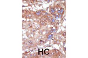 Formalin-fixed and paraffin-embedded human hepatocellular carcinoma tissue reacted with TNK2 polyclonal antibody  , which was peroxidase-conjugated to the secondary antibody, followed by AEC staining.