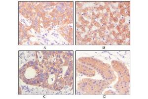 Immunohistochemical analysis of paraffin-embedded human lung squamous cell carcinoma (A),normal hepatocyte (B), colon adenocacinoma? (Cytokeratin 1 anticorps)