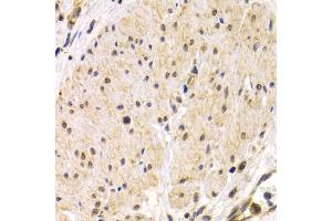 Immunohistochemistry of paraffin-embedded human stomach cancer using TMPRSS2 antibody. (TMPRSS2 anticorps)