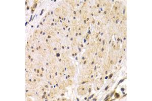 Immunohistochemistry of paraffin-embedded human stomach cancer using TMPRSS2 antibody. (TMPRSS2 anticorps)