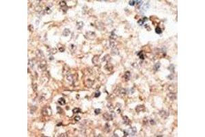 IHC analysis of FFPE human hepatocarcinoma tissue stained with the Osteocalcin antibody (Osteocalcin anticorps  (AA 2-32))