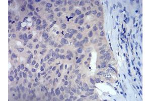 Immunohistochemical analysis of paraffin-embedded ovarian cancer tissues using FOXP3 mouse mAb with DAB staining.