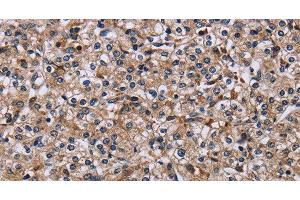 Immunohistochemistry of paraffin-embedded Human prostate cancer using IPO4 Polyclonal Antibody at dilution of 1:50 (Importin 4 anticorps)
