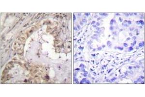 Immunohistochemistry analysis of paraffin-embedded human lung carcinoma tissue, using BCL-XL (Ab-47) Antibody. (BCL2L1 anticorps  (AA 13-62))
