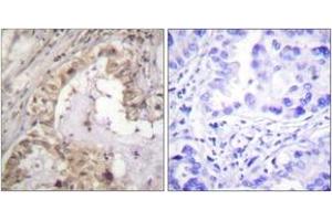 Immunohistochemistry analysis of paraffin-embedded human lung carcinoma tissue, using BCL-XL (Ab-47) Antibody.