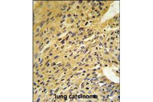 COQ5 Antibody IHC analysis in formalin fixed and paraffin embedded human lung carcinoma followed by peroxidase conjugation of the secondary antibody and DAB staining. (COQ5 anticorps  (AA 213-241))