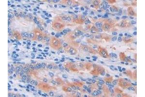 Detection of Pgp in Human Stomach cancer Tissue using Polyclonal Antibody to Permeability Glycoprotein (Pgp)