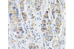 Immunohistochemistry of paraffin-embedded Human liver cancer using VAPB Polyclonal Antibody at dilution of 1:200 (40x lens). (VAPB anticorps)