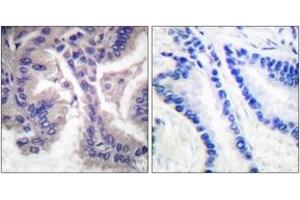 Immunohistochemistry analysis of paraffin-embedded human lung carcinoma tissue, using Caspase 6 (Cleaved-Asp162) Antibody.