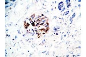 Human pancreas cancer tissue was stained by Rabbit Anti-GLP-1(7-36) -NH2 Antibody